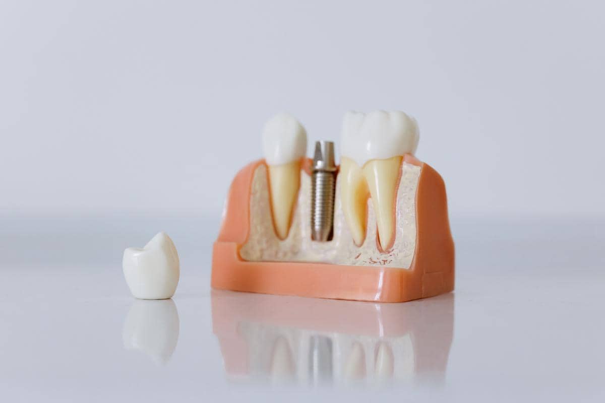 Dental Bridge (Gigi Tiruan Jembatan): Solusi Senyum Rapi dan Fungsi Kunyah Optimal