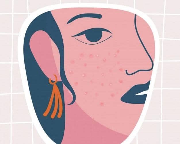 5 Rekomendasi Skincare untuk Acne Prone Skin, dari Cleansing Oil hingga Sunscreen